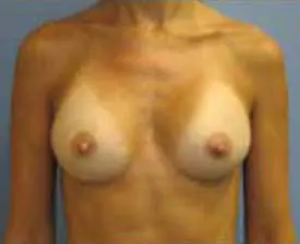 Breast Augmentation Before and After Pictures St. Louis, MO