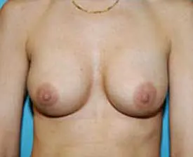 Breast Augmentation Before and After Pictures St. Louis, MO