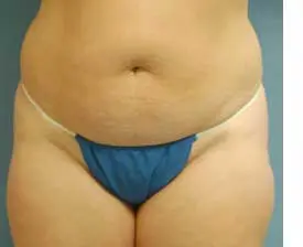 Liposuction Before and After Pictures St. Louis, MO