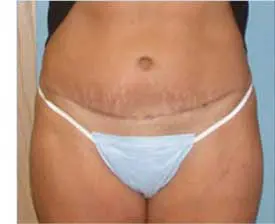 Tummy Tuck Before and After Pictures St. Louis, MO