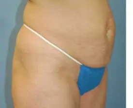 Tummy Tuck Before and After Pictures St. Louis, MO
