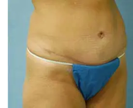 Tummy Tuck Before and After Pictures St. Louis, MO