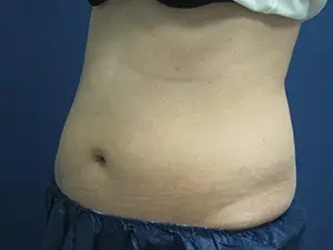 CoolSculpting® Before and After Pictures St. Louis, MO