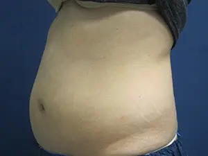 CoolSculpting® Before and After Pictures St. Louis, MO