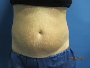 CoolSculpting® Before and After Pictures St. Louis, MO