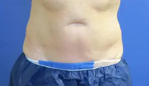 CoolSculpting® Before and After Pictures St. Louis, MO