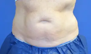 CoolSculpting® Before and After Pictures St. Louis, MO