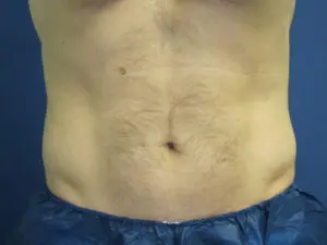 CoolSculpting® Before and After Pictures St. Louis, MO
