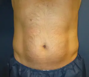 CoolSculpting® Before and After Pictures St. Louis, MO