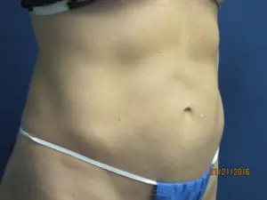CoolSculpting® Before and After Pictures St. Louis, MO
