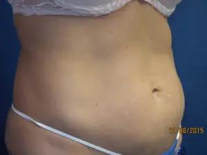 CoolSculpting® Before and After Pictures St. Louis, MO