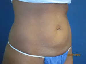 CoolSculpting® Before and After Pictures St. Louis, MO