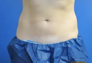 CoolSculpting® Before and After Pictures St. Louis, MO