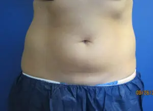 CoolSculpting® Before and After Pictures St. Louis, MO