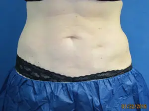 CoolSculpting® Before and After Pictures St. Louis, MO