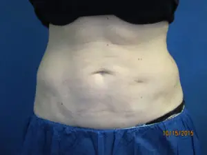 CoolSculpting® Before and After Pictures St. Louis, MO