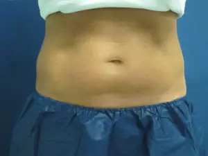 CoolSculpting® Before and After Pictures St. Louis, MO