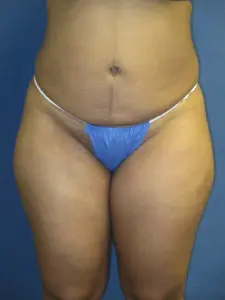 Liposuction Before and After Pictures St. Louis, MO