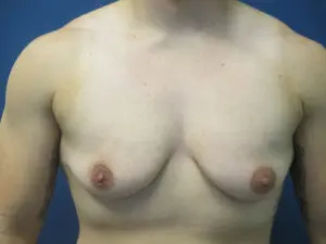 Gender Affirming Male Before and After Pictures St. Louis, MO