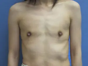 Breast Augmentation Before and After Pictures St. Louis, MO