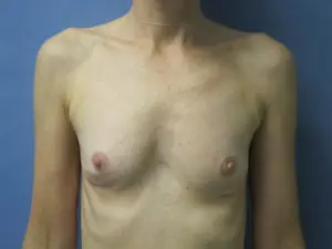 Implant Removal Before and After Pictures St. Louis, MO