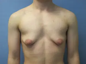 Gender Affirming Male Before and After Pictures St. Louis, MO