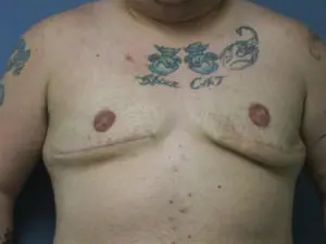 Gender Affirming Male Before and After Pictures St. Louis, MO