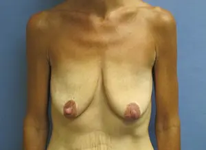 Breast Lift Before and After Pictures St. Louis, MO