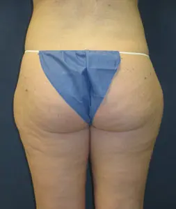 Liposuction Before and After Pictures St. Louis, MO