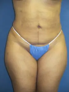 Liposuction Before and After Pictures St. Louis, MO