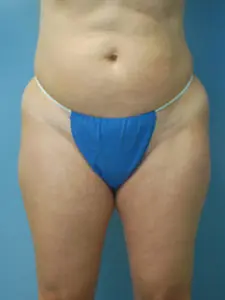 Liposuction Before and After Pictures St. Louis, MO