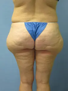 Liposuction Before and After Pictures St. Louis, MO