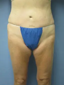 Liposuction Before and After Pictures St. Louis, MO