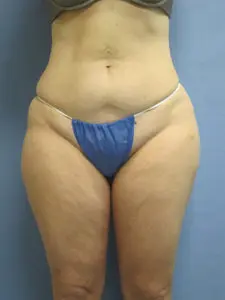 Liposuction Before and After Pictures St. Louis, MO