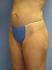 Liposuction Before and After Pictures St. Louis, MO
