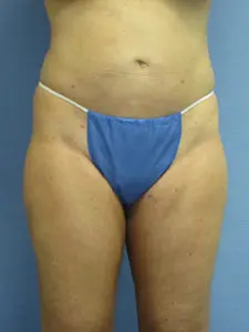 Liposuction Before and After Pictures St. Louis, MO