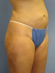 Liposuction Before and After Pictures St. Louis, MO