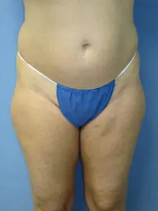 Liposuction Before and After Pictures St. Louis, MO
