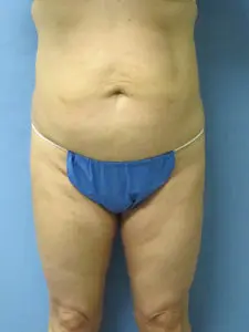 Liposuction Before and After Pictures St. Louis, MO