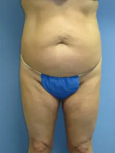 Liposuction Before and After Pictures St. Louis, MO