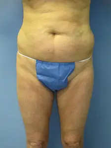 Liposuction Before and After Pictures St. Louis, MO