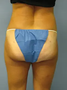 Liposuction Before and After Pictures St. Louis, MO