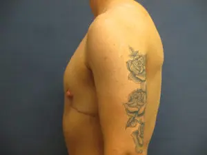 Gender Affirming Male Before and After Pictures in St. Louis, MO