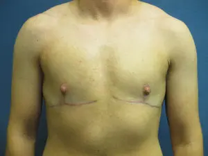 Gender Affirming Male Before and After Pictures in St. Louis, MO