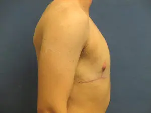 Gender Affirming Male Before and After Pictures in St. Louis, MO