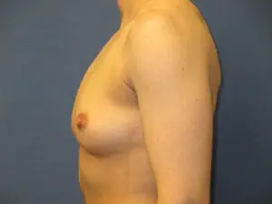 Gender Affirming Male Before and After Pictures in St. Louis, MO