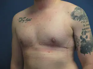 Gender Affirming Male Before and After Pictures in St. Louis, MO