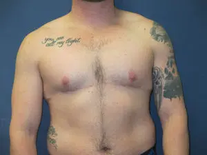 Gender Affirming Male Before and After Pictures in St. Louis, MO