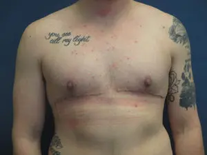 Gender Affirming Male Before and After Pictures in St. Louis, MO