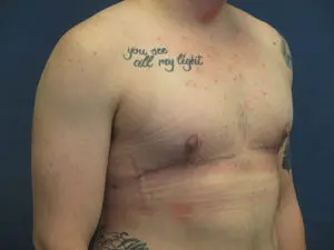 Gender Affirming Male Before and After Pictures in St. Louis, MO